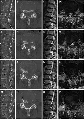 Recompression after percutaneous transforaminal endoscopic decompression for degenerative lumbar spinal stenosis: risk factors and outcomes of two different reoperation procedures